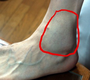 ankle-swelling